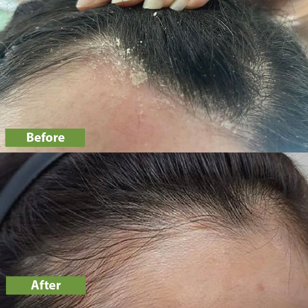 Anti-dandruff Kit