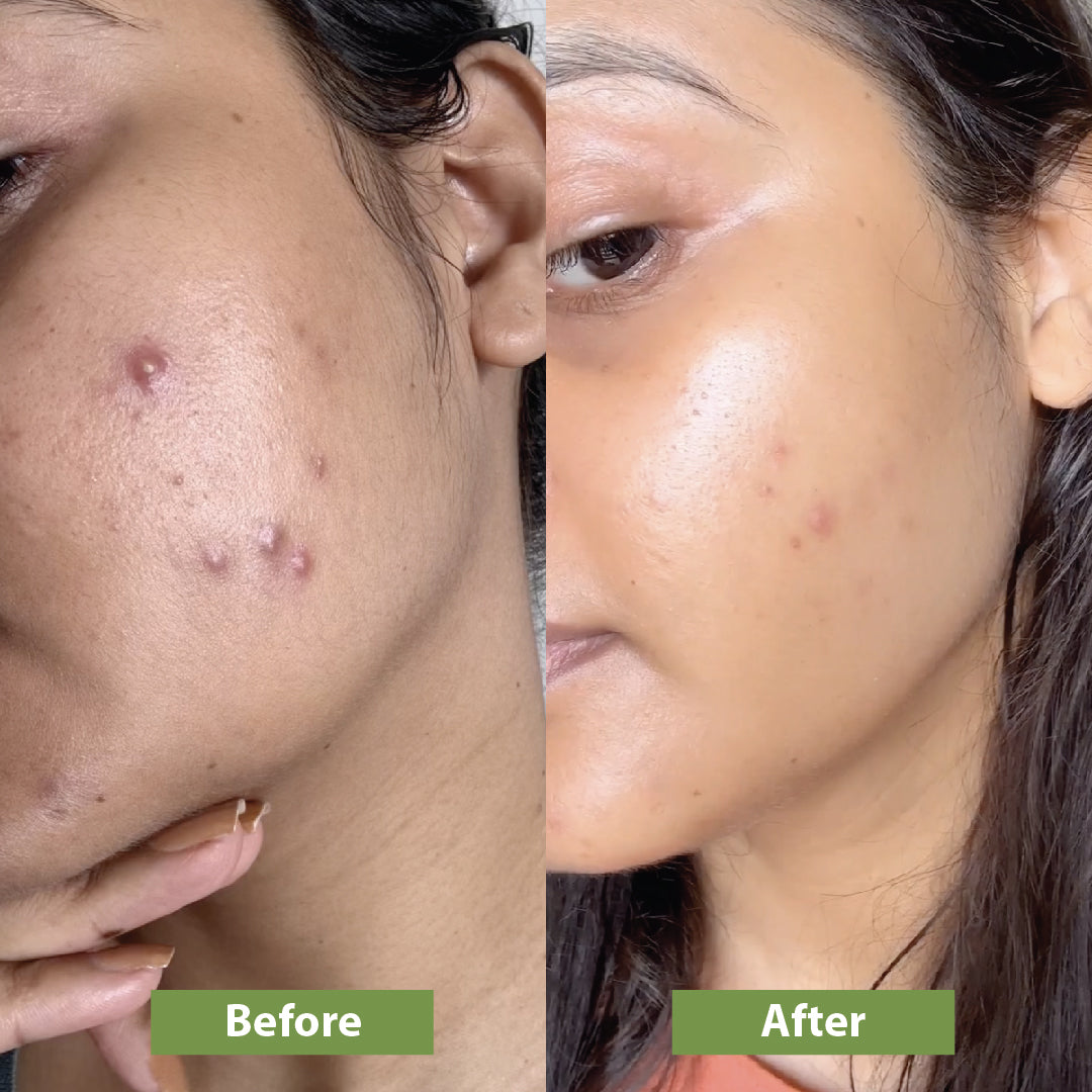 Anti-acne Kit