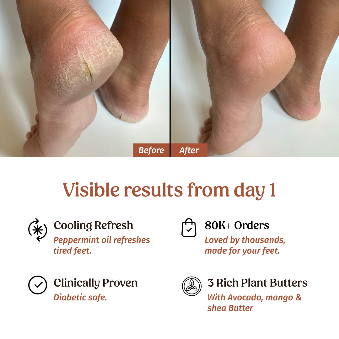 Foot Cream Pack of 2 (Treats Cracked Heels)