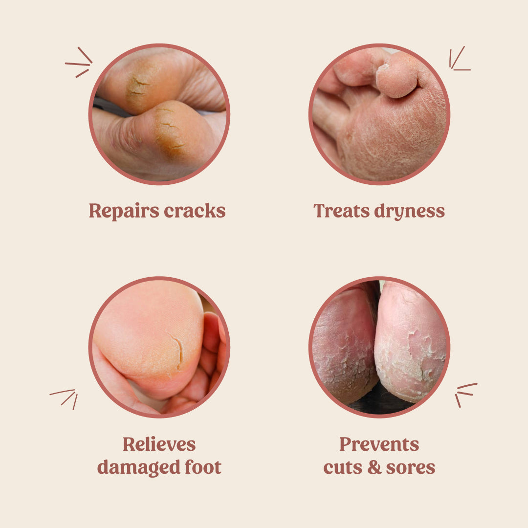 Foot Cream (Treats Cracked Heels)